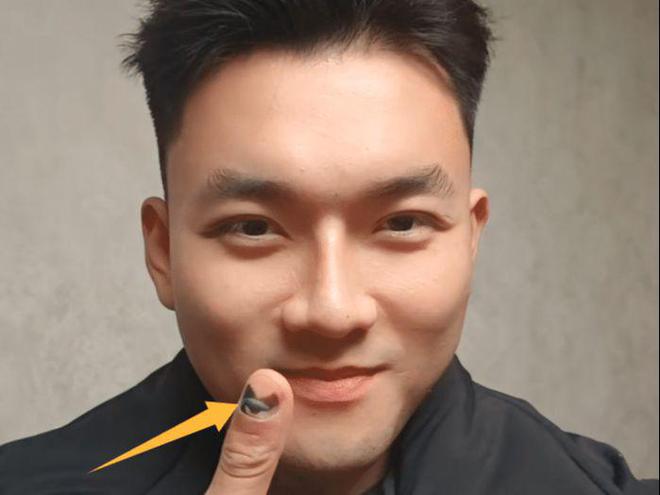 手指肿得像鸡蛋不开口被质疑遭割舌！球王会网页版杨泽琪展示身上伤痕自曝(图1)