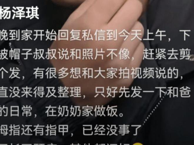 手指肿得像鸡蛋不开口被质疑遭割舌！球王会网页版杨泽琪展示身上伤痕自曝(图3)