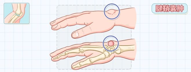 事?腱鞘囊肿需要开刀吗?手腕上长了个包是怎么回(图4) 事?腱鞘囊肿需要开刀吗?手腕上长了个包是怎么回(图4)